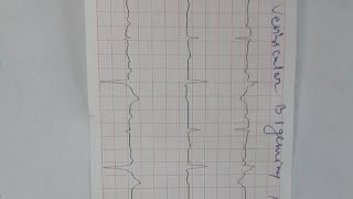 ventricular bigeminy and trigeminy [upl. by Kursh7]