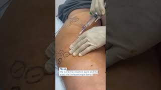 Aveli Cellulite Reduction with Dr Zuri in Miami  Zuri Plastic Surgery [upl. by Arlie498]