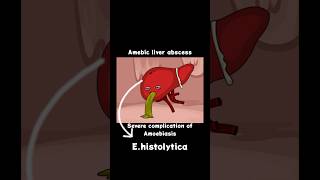 quotAmoebic Liver Abscess key points  Quick Diagnosis amp Treatment Explainedquot ocean of medicine [upl. by Nyrrat191]