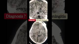 Subdural collection  Meningitis  NCCT Brain  Diagnosis  Radiology [upl. by Tome]