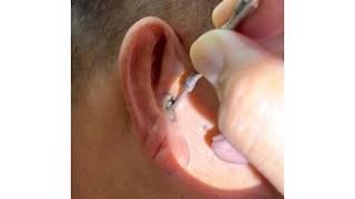 Removing Grandpas 70 Year Old Hard Earwax [upl. by Lika]