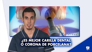 CARILLA dental o CORONA  ¿Qué es mejor ¿Cuál dura más  Shorts [upl. by Fielding869]