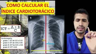 INDICE cardiotorácico Cardiomegalia [upl. by Pheni750]