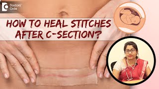 6 Tips to Take Care of Stitches amp Heal Fast After CSection DrSupritha Rangaswamy Doctors Circle [upl. by Vasos934]