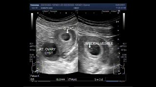 Early Pregnancy of about six weeks with an ovarian cyst [upl. by Ahsiym]