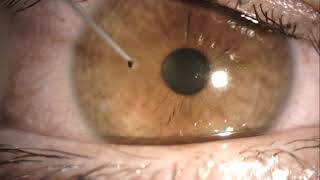 corneal foreign body removal like a boss [upl. by Hernando]