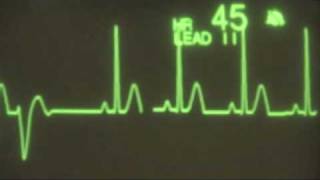 Sinus Rhythm with PVCs  ECG Training [upl. by Leggat]