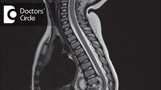 When will the pain due to Spinal TB subside if ESR has reduced  Dr Mohan M R [upl. by Myrtice]