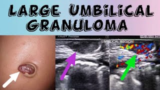 Large Umbilical Granuloma  Umbilical Swelling Ultrasound [upl. by Meirrak]