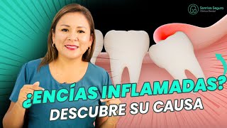 ¡EMERGENCIA DENTAL Cómo Aliviar las Encías Inflamadas por una Muela del Juicio [upl. by Accalia]