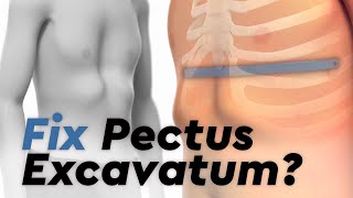 Pectus Excavatum and the Nuss Procedure [upl. by Monjan390]