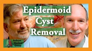 Epidermoid Cyst Removal INTACT Auburn Medical Group [upl. by Yddet]