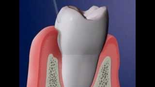 Atridox Medication for Periodontal Disease Treatment  Lake Merritt Dental Oakland CA [upl. by Rolph]