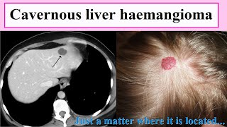 cavernous liver haemangioma [upl. by Arracahs]