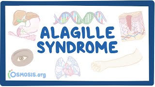 Alagille Syndrome causes symptoms diagnosis treatment pathology [upl. by Dorice632]