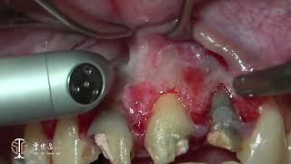 Recession Coverage via Soft Tissue Substitute Frenectomy amp Apicoectomy in Aesthetic Zone III [upl. by Kir]