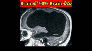 వ్యక్తికి 90 Brain లేదు😱shorts facts factshortsshortsfeed [upl. by Benson422]