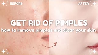 how to get rid of pimples and clear your skin 🧴🫧 acne treatments and dos and donts [upl. by Joslyn235]