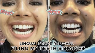 Filing roundchipped teeth straight enameloplasty amp inbrace lingual braces removal day [upl. by Teddy878]