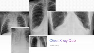 Chest Xray Quiz Atelectasis [upl. by Paulsen]