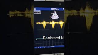 Severe heavily calcified AV stenosis 😱HeartHealth CalciumBuildup echocardiogram echocardiography [upl. by Ydnec]