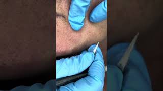 Watch Electrolysis Hair Removal in Action [upl. by Assyn]