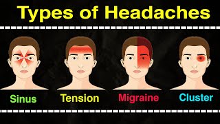 Headache Types Explained Sinus Migraine Cluster amp Tension Relief Tips headachetreatment [upl. by Assyn]