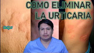 COMO ELIMINAR LA URTICARIA  RONCHAS [upl. by Ynnoj962]