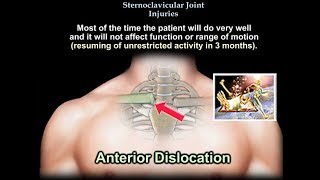 Sternoclavicular Joint Injuries  Everything You Need To Know  Dr Nabil Ebraheim [upl. by Arikahc]