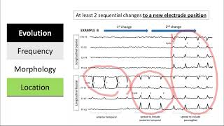 Clinical and Electrographic Seizures [upl. by Adnirem319]