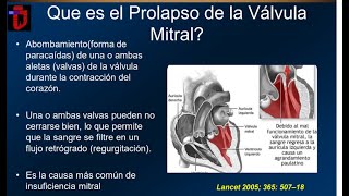 Prolapso de la Válvula Mitral [upl. by Ilojne]