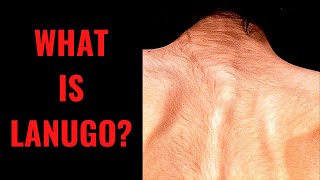 WHAT IS LANUGO  Causes Removal Anorexia Newborn [upl. by Kutchins958]