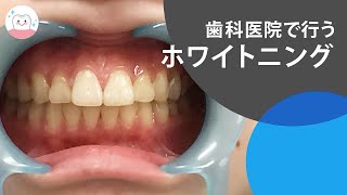 歯医者さんでしてもらうホワイトニングで元の綺麗な歯に Teeth Whitening From the Dentist [upl. by Lazarus]