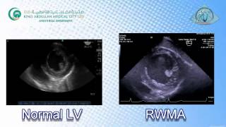 050 Regional LV Function RWMA TEE KAMC [upl. by Tj]