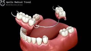 Animated Removable Partial Dentures  Apollo Medical Travel [upl. by Unni207]