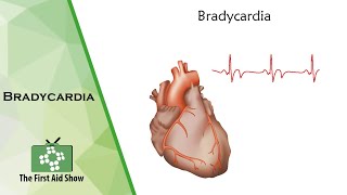 Bradycardia [upl. by Derr]