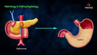 ZollingerEllison syndrome ZES  Animated lecture usmle step 1 pathology  Dr Bhanu prakash [upl. by Siuluj883]