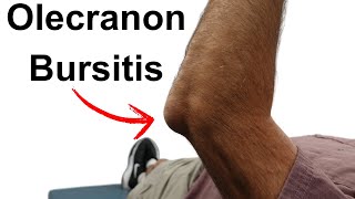 Olecranon Bursitis [upl. by Paz]