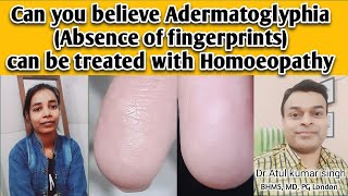 adermatoglyphia Absence of fingerprints can be treated by Homoeopathic intervention [upl. by Obola943]