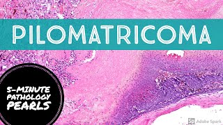 Pilomatricoma 5Minute Pathology Pearls [upl. by Schonfeld]