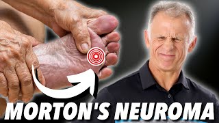 Mortons Neuroma Absolute Best Treatment In Our Opinion [upl. by Ennaerb]