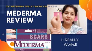 Mederma Cream Review for AcneBurn Scars and Stretch Marks [upl. by Ches717]