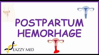 Postpartum Hemorrhage PPH causesrisk factorsprevention and treatment [upl. by Moberg]