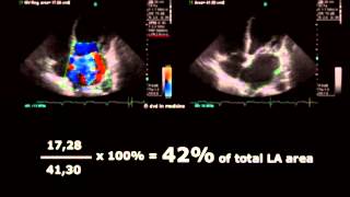 Volodymyr Pavliuk MD PhD Echocardiographic Assesment of Mitral Regurgitation [upl. by Bell490]