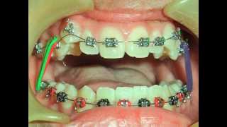 ORTHODONTIC TREATMENT NO 12  Class 1 CROWDING [upl. by Cirri901]