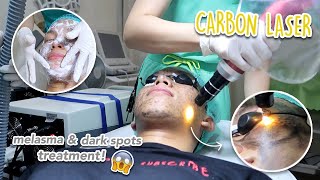 FIRST Carbon Laser Treatment for Melasma Dark Spots amp Hyperpigmentation Philippines [upl. by Micheal]