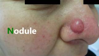 papule pustule vesicule bulle nodule macule [upl. by Annoyek]