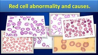 Red cell abnormality and causes [upl. by Alebasi]