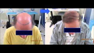 dr AMAR greffe de cheveux implant capillaire FUE calvitie docteur AMAR alopécie [upl. by Adur881]