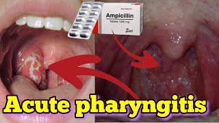 acute pharyngitis treatment in hindiगले की खराश  Sore throat  का कारण  लक्षण और इलाज [upl. by Cruz]